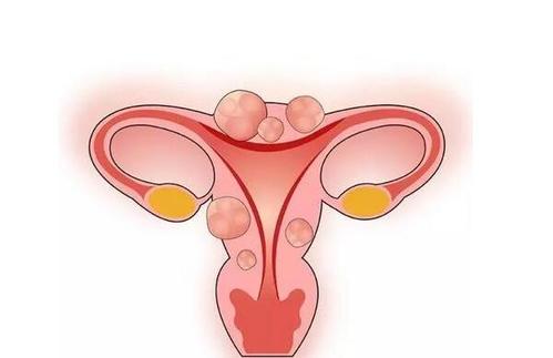昆明女性子宫肌瘤有哪些典型症状